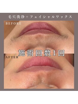 ベルミー(Bellmi)/毛穴洗浄＋フェイシャルワックス