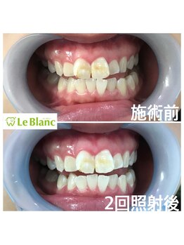 ルブラン 奈良店(Le Blanc)/前歯の着色汚れ