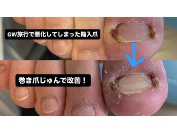 GW後に増加中！陥入爪の強い痛み