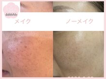 サクラ(SAKURA)/神奈川初導入★都内で受ける施術