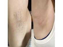 オフオルファヴォリ(OF Olu:Favori)/【フラッシュワックス脱毛】