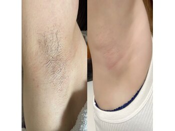 オフオルファヴォリ(OF Olu:Favori)/【フラッシュワックス脱毛】