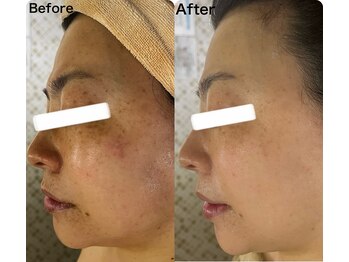 マーレン(Malen)/【クリスティーナ症例写真】