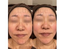 プライベートサロン ルクサージュ(Luxeage)/深部から改善ポレーション導入