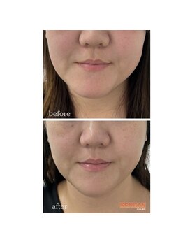 センガン(SENGAN)/フェイスラインをスッキリ