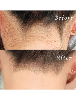 ララリア(LaLaLia)/うなじWAX脱毛