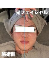 ネオファースト 大阪福島店(NeoFirst)/光フェイシャル#毛穴#毛穴洗浄