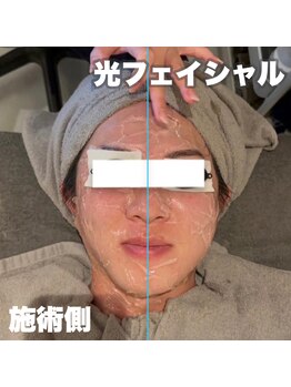 ネオファースト 大阪福島店(NeoFirst)/光フェイシャル#毛穴#毛穴洗浄