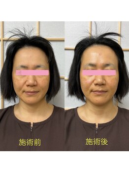 アキュピタル(acupital)/美容鍼灸 BeforeAfter