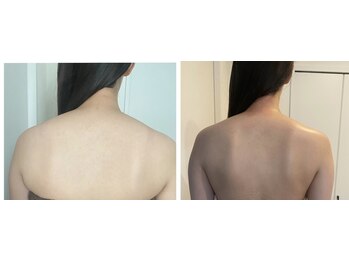 ラトナ(Ratna)/【結果写真】ブライダル痩身1回