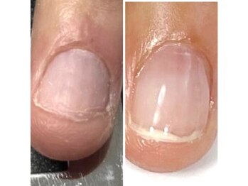 エルアンド(elle＆)/皮膚より爪が短い深爪さんも改善