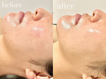 クク(ququ)/生理前の肌荒れも