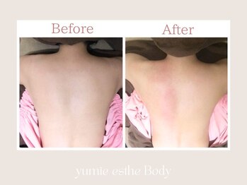 トータルビューティー ゆみえエステ(Total Beauty)/痩身/ハイパーナイフ/背中