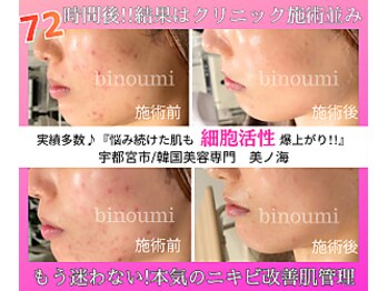 美ノ海/長年悩んだニキビも１回で実感♪