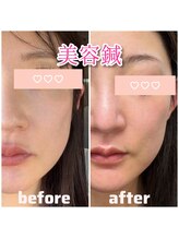 きむら整骨院 鍼灸院/美容鍼