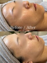 ルラシェ(Relacher)/温石×ハーブピーリング