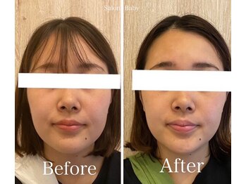 サロンベイビー 西宮本店(Salon Baby)/【BeforeAfter】小顔美容整顔