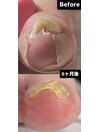 激変巻き爪ケア