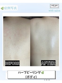 ウィズサロン(withサロン)の写真/結果重視のお客様におすすめのハーブピーリング/美しい素肌へ本気の肌改善ハーブピーリング¥9800