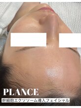 プランス 福岡(PLANCE)/エクソソームエステ　福岡天神