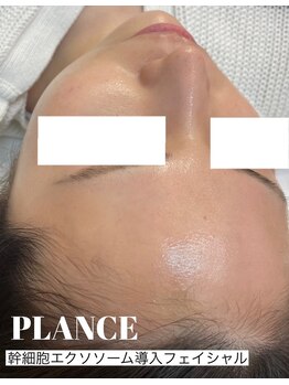 プランス 福岡(PLANCE)/エクソソームエステ　福岡天神