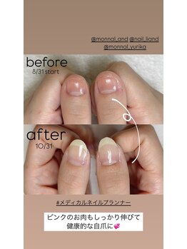 リアンド(Li&)/【深爪・トラブル爪】美爪育成