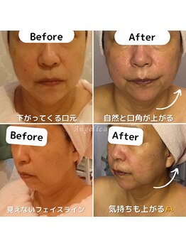 アンジェリカ(Angelica)/60代から始める！たるみケア