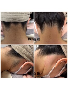 フルールスレーヌ(Fleur Sereine)/シュガーリング&光でダブル脱毛