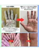 もりさわ治療院 与力町治療室 &nbsp;トサカ(TOSAKA)/シグナル療法（酵素ローション）