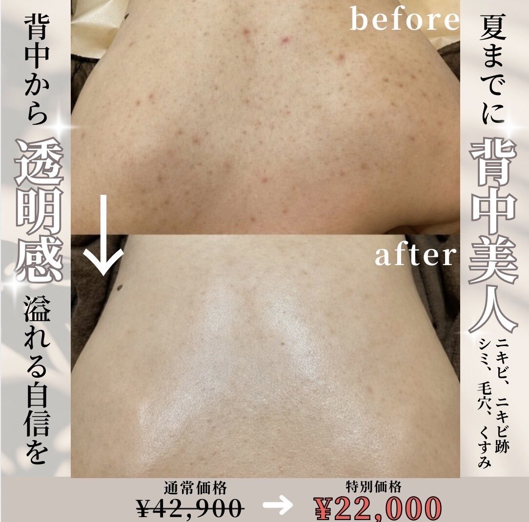 ８月来店限定・背中美人！ハーブピーリング×IPLでニキビ・色素沈着徹底改善