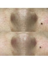 ダリアビューティー(Dahlia Beauty)/ハイドラbefore after