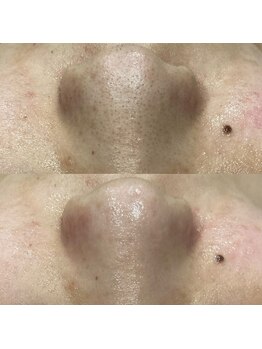 ダリアビューティー(Dahlia Beauty)/ハイドラbefore after