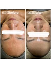 ミニョン(mignon)/シワ、タルミケア大事です！