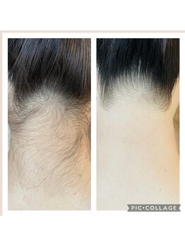 キッキー(Kicky)/名古屋NO1うなじ脱毛目指して