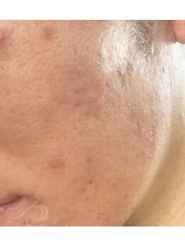 リベル 名古屋(Lebelle:)/ハーブピーリング専門名古屋