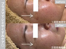 サロン ビュー(salon view)/30代女性〈シミ悩み〉　