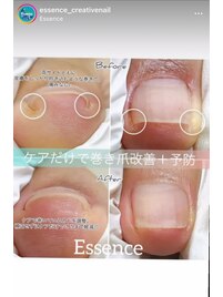 ケアで巻き爪の進行を予防◎