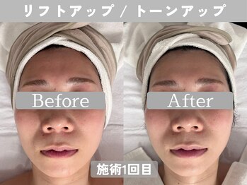 ミピマム 町田店/リフトアップとトーンアップ♪