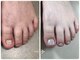 ブルームーンネイルズ(BLOOMOON.nails)の写真/【フットの深爪のお悩みに。その日のうちに見た目の変化を実感◎サンダルも楽しめる足元へ】