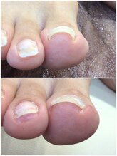 モアクリスタル(More Crystal)/巻き爪補正