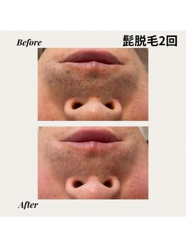 ノースフェイシャルズ(North facials)/髭脱毛