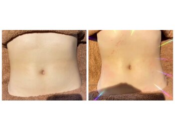 セラヴィ(CELAVIE)/腸美養トリートメント