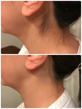 ノノ(nono)/うなじ脱毛！