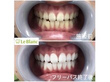 ルブラン 奈良店(Le Blanc)/別人のような白さ！