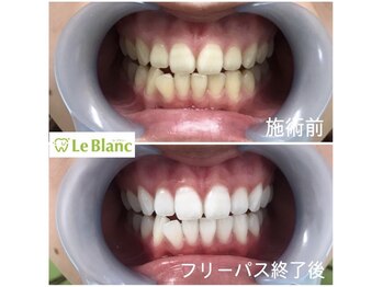 ルブラン 奈良店(Le Blanc)/別人のような白さ!