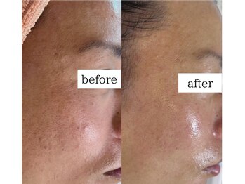 エクレ(eclat)/《殺菌効果》毛穴の開きキュッ！