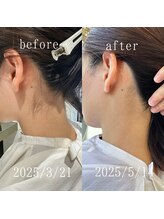 アゲハ(ageha)/レディース/うなじ脱毛