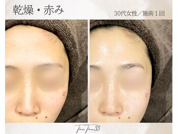 スリースリー(THREE THREE)/乾燥・赤みケア