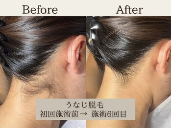 インベスト(INVEST)/うなじ脱毛