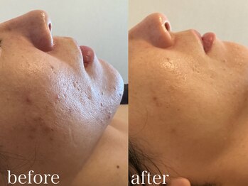 グレイティア(gratia)/韓国肌管理ララピール